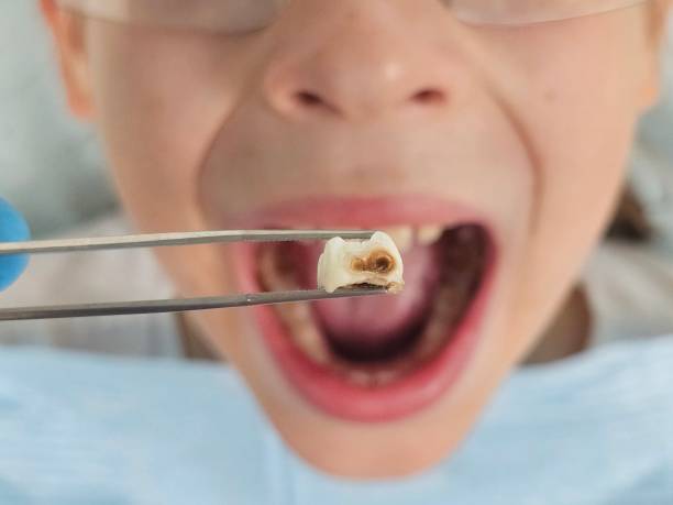 Best Emergency Dental Care for Abscessed Tooth in Gordon, PA